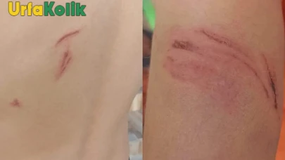 Hilvan'da Sokak Köpeği Saldırısı: Minik Enes Yaralandı, Vatandaşlar İsyan Etti