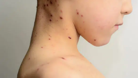 Bangladeş’te Kızamık Alarmı: 6 Haftada 113 Çocuk Hayatını Kaybetti