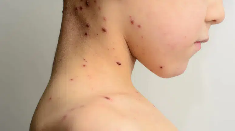 Bangladeş’te Kızamık Alarmı: 6 Haftada 113 Çocuk Hayatını Kaybetti